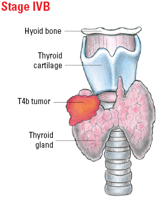 Thyroid_Med_IVB.png